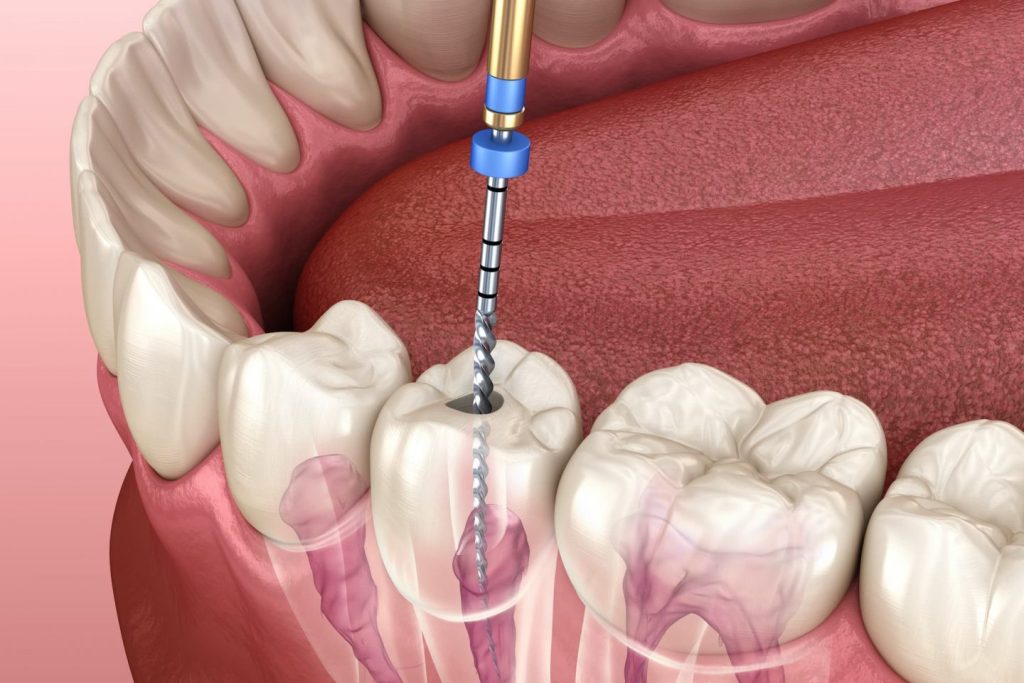 What Is The Procedure Of A Root Canal Treatment