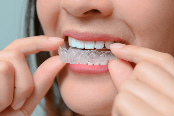 Debunking Common Myths About Orthodontic Treatments