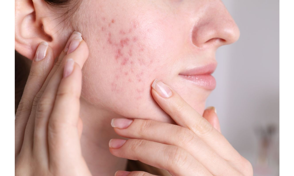 7 Questions to Ask an Acne Scar Physician During Your First Visit