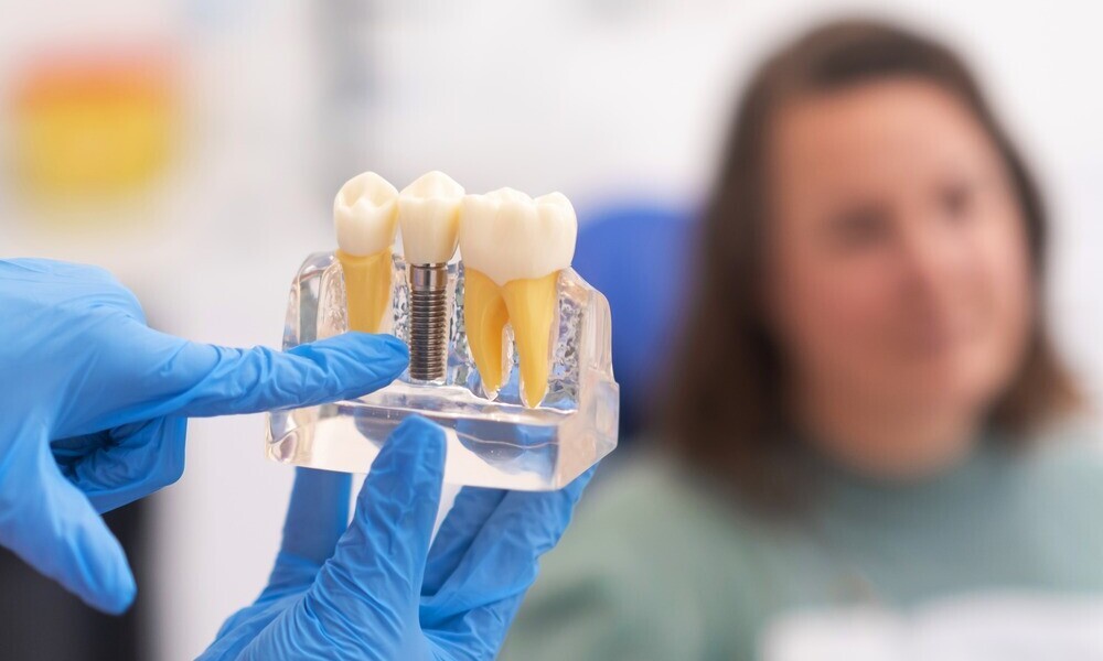 Dental Implants Explained: Procedure, Benefits, and Longevity