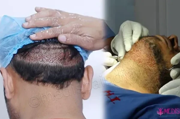 Who Is the Ideal Candidate for FUE + FUT + BHT Combination Hair Transplant?