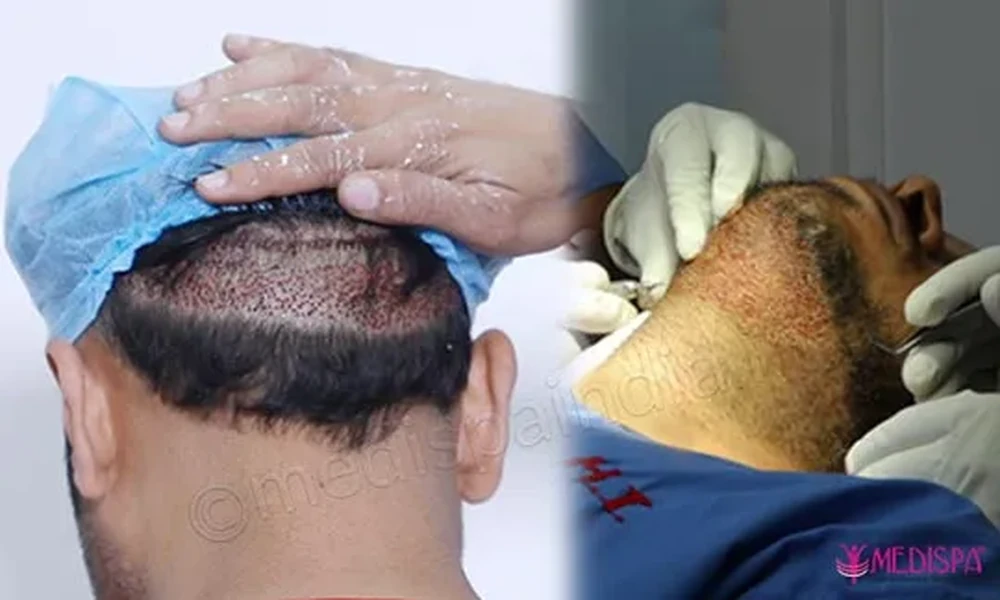 Who Is the Ideal Candidate for FUE + FUT + BHT Combination Hair Transplant?