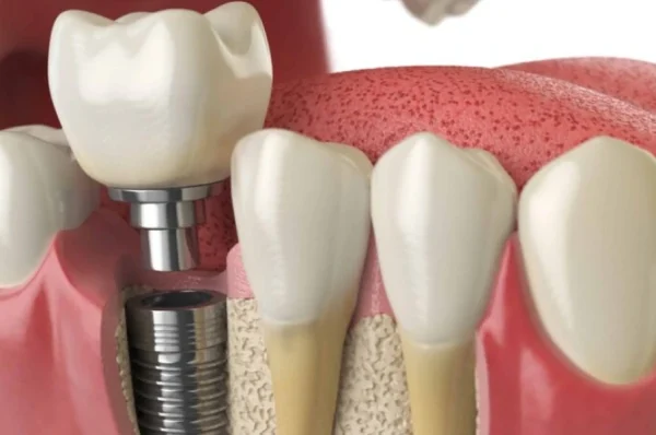 Are You a Candidate for Dental Implants? Key Factors That Determine Treatment Success