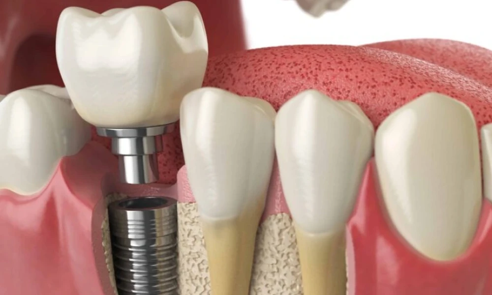 Are You a Candidate for Dental Implants? Key Factors That Determine Treatment Success